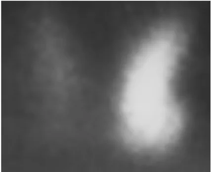 Figure    12 12 12: Scintigraphie au technétium  12 99 99 99 99 T T montrant un lobe thyroïdien gauche,  T T