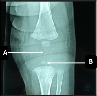 Figure 12    :   :   :   :  Radiographie du genou montrant : un élargissement de l’interligne articulaire   (témoignant d’un épanchement articulaire) (A) avec atteint épiphysaire tibiale confirmée à 