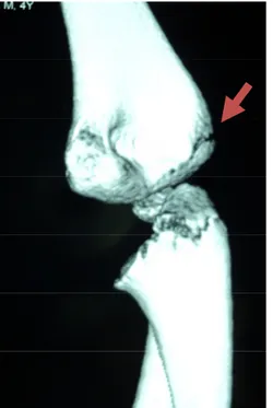 Figure 12 2 2 2 : Un scanner du coude d’un patient de 4 ans avec reconstruction tridimensionnelle  montrant une fracture du condyle externe de stade I avec un trait de fracture de type I de Milch 