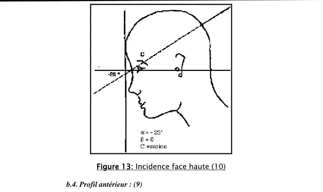Figure 13 13 13:  13 :  : Incidence face haute (10)     : 