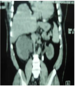 Figure n°7 : uroscanner ,en reconstruction coronale après injection de PDC,  montrant un calcul  de l’uretère lombaire gauche