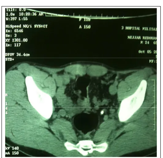 Figure 3 : TDM sans injection montrant un calcul urétéral pelvien gauche 