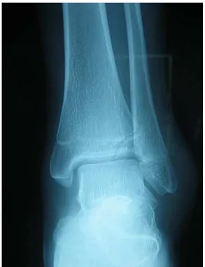 Figure 13 : fracture de MacFarland non déplacé de l’extrémité inférieure du tibia  chez un enfant de 12 ans 