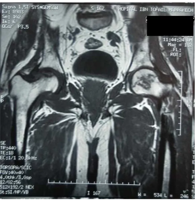 Figure 7 7 7 7    :  :  :  : IRM des hanches du patient n°1 montrant : 