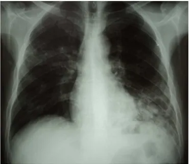 Figure 2 2 2 2     :  :  :  :  Tuberculose pulmonaire commune : opacité hilo-axillaire gauche dense  hétérogène mal limitée (syndrome alvéolaire) siège de multiples excavations avec des 