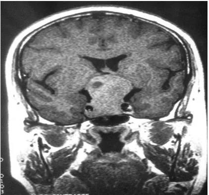 Figure  6:::: IRM en Coupe coronale T1 : macro-adénome à développement supra-sellaire  comprimant le 3éme ventricule