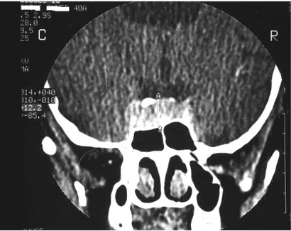 Figure     8 8 8 8 : TDM cérébrale en coupe coronale montrant  un amincissement du plancher sellaire