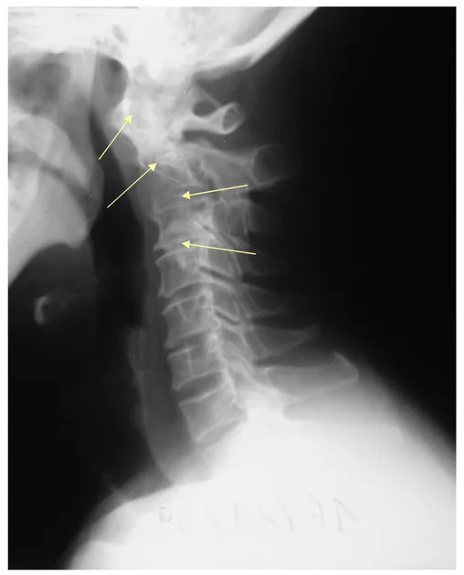 Figure 3 3 3 3    :::: Radiographie du rachis cervical de profil montrant   Rectitude du rachis cervical ; 