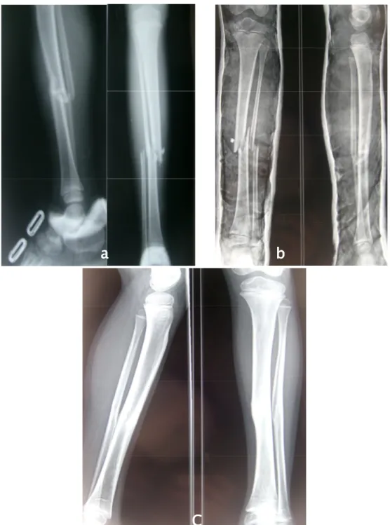 Figure 6    :::: Traitement orthopédique d’une fracture fermée chez un enfant  de 6 ans 