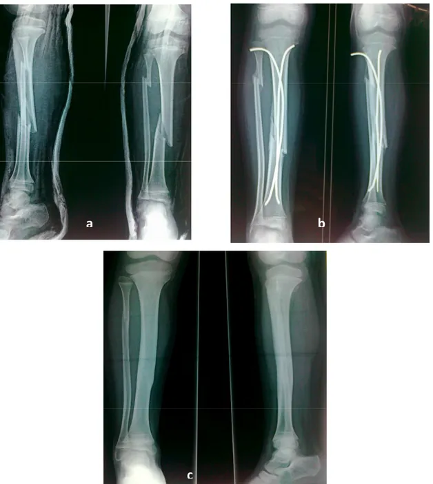 Figure    7 7 7 7    :::: Fracture de jambe traitée d’emblée par ECMES 