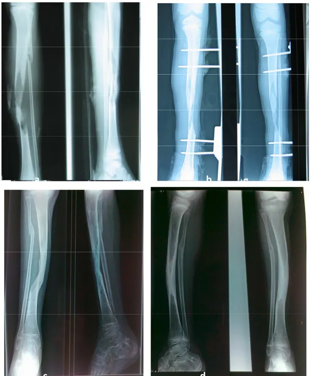 Figure 8    :::: Fracture complexe de la jambe gauche avec perte de substance osseuse