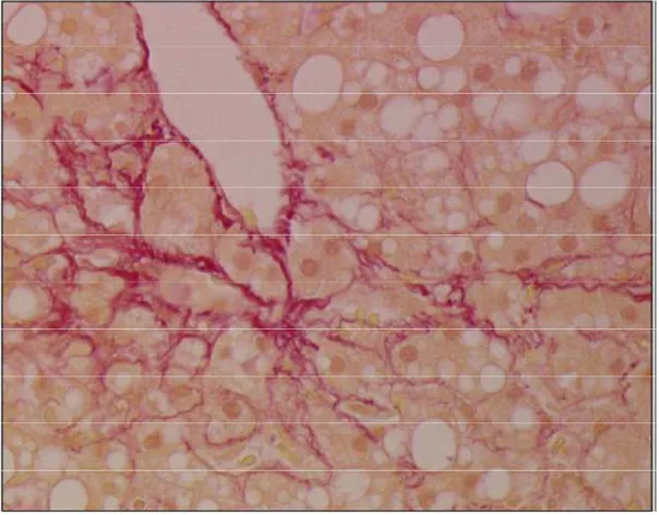 Figure    2 2 2    :  2 :  :  :  Fibrose péisinusoïdale (coloration rouge sirius) [1]