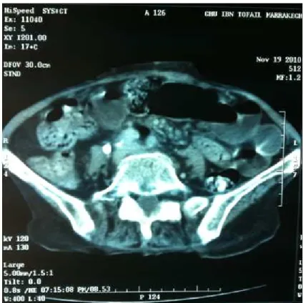 Figure    9 9 9 9:  :  :  : TDM    en coupe transversale montrant faces sign en faveur  d’une occlusion intestinale 