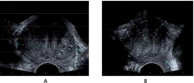 Figure 6:::: Image échographique de la prostate en coupe axiale(A) et coupe sagittale (B)