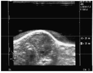 Figure 4 : Echographie cervicale montrant  