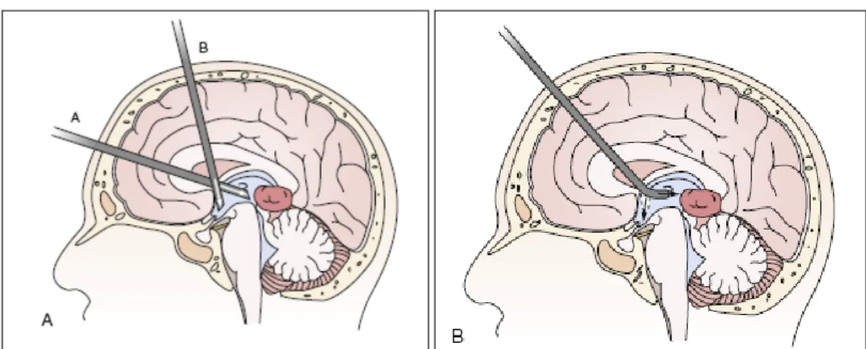 Figure 37 : Biopsie endoscopique d’une tumeur de la région pinéale lors d’une VCS. 