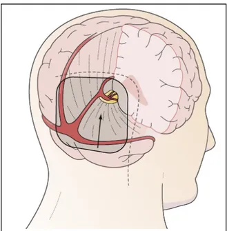 Figure 38 : La voie occipitale transtentorielle : La trajectoire de la voie,   l’incision de la peau, et la position de la craniotomie.[2] 