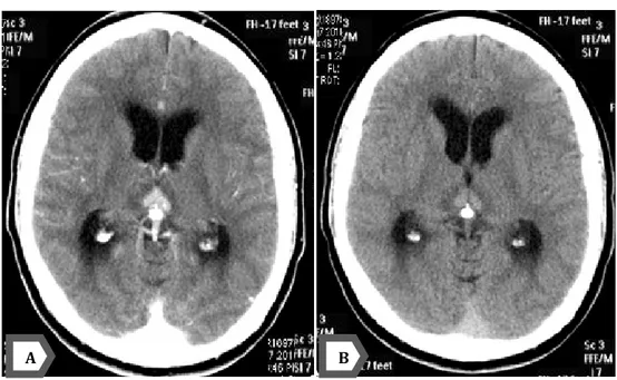 Figure 12 a : TDM cérébrale en coupes axiales sans (A) et avec injection de produit de contraste  (B) montrant un processus lésionnel de la région pinéale spontanément hyperdense, prenant le 