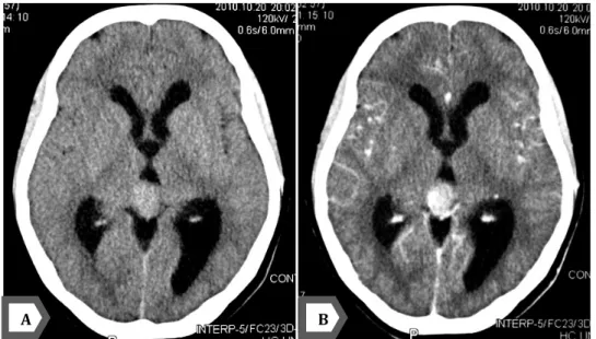 Figure 13 a : TDM cérébrale en coupes axiales sans (A) et avec injection de produit de contraste  (B) montrant processus lésionnel de la région pinéale spontanément hyperdense, prenant le 