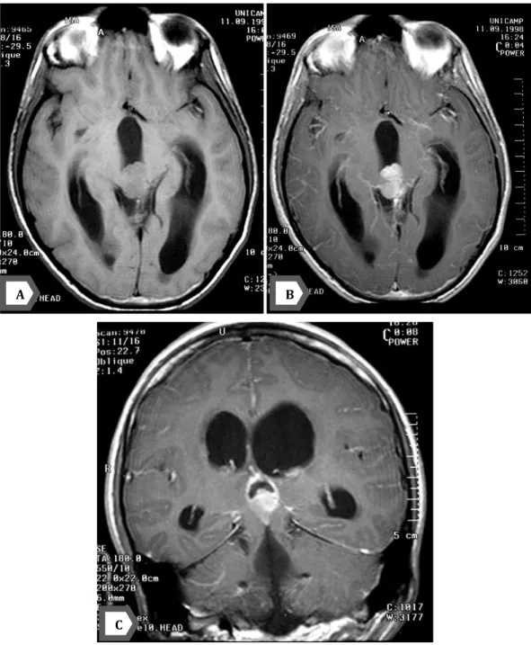 Figure 14 : IRM cérébrale en coupe axiale en séquence T1 sans (A) et avec injection du  Gadolinium(B), et en coupe coronale après injection du Gadolinium (C), montrant un processus 