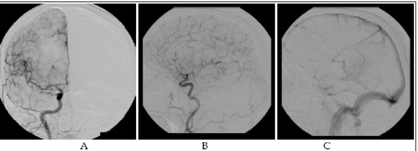 Figure 32 : Angiographie préopératoire d’un méningiome de la région pinéale [49] : le blush  tumoral est léger (A- B)