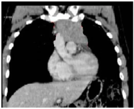 Figure 13: coupe de TDM pré chirurgicale montrant une hyperplasie thymique  en place avec ses  rapports