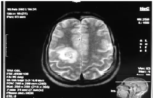 Figure n°13 : IRM cérébrale en coupe axiale en séquence pondérée T2 avec injection de  gadolinium montrant une formation arrondie bien limitée, prérolandique du côté droit, avec  œdème hyperintense, ainsi que le centre mais moucheté, hétérogène avec présence d’un halo 
