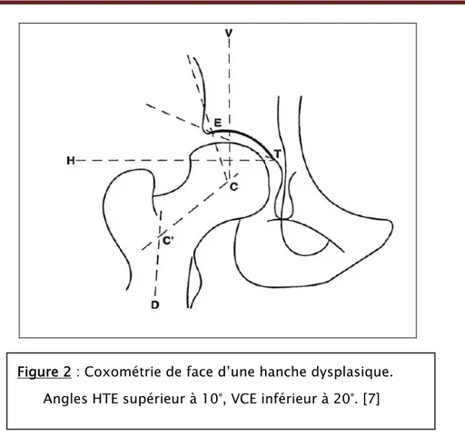 Figure 2 : Coxométrie de face d’une hanche dysplasique.         Angles HTE supérieur à 10°, VCE inférieur à 20°