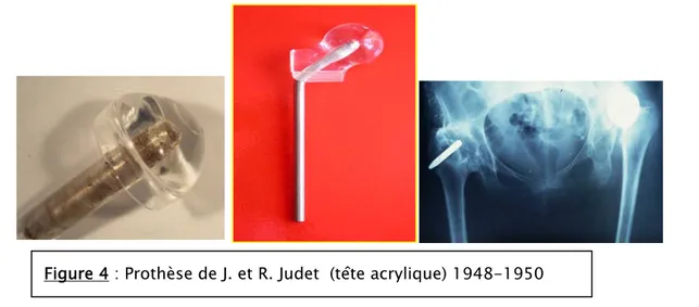 Figure 4 : Prothèse de J. et R. Judet  (tête acrylique) 1948-1950 