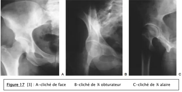 Figure 17  [3] : A-cliché de face       B-cliché de ¾ obturateur          C-cliché de ¾ alaire 