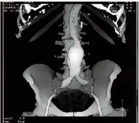 Figure 4 :image de reconstruction montrant un anévrysme de l’aorte abdominale   sous-rénale étendu aux artéres iliaques(Pr M.Alaoui) 