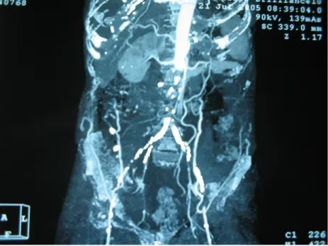 Figure 6  : Image  scanographique d’une occlusion totale de l’aorte  abdominale au ras des artéres rénales  (Pr.M.Alaoui).