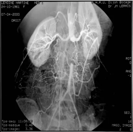 Figure 7 :Image d’artériographie objectivant une occlusion totale de l’aorte abdominale au ras  des artéres rénales avec reprise  