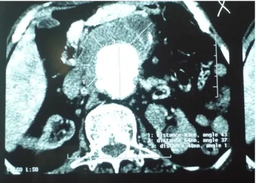 Figure 9 :Coupe transversal scannographique d’un anévrysme de l’aorte abdominale sous-rénal  mesurant 75 mm (Pr M.Alaoui) 