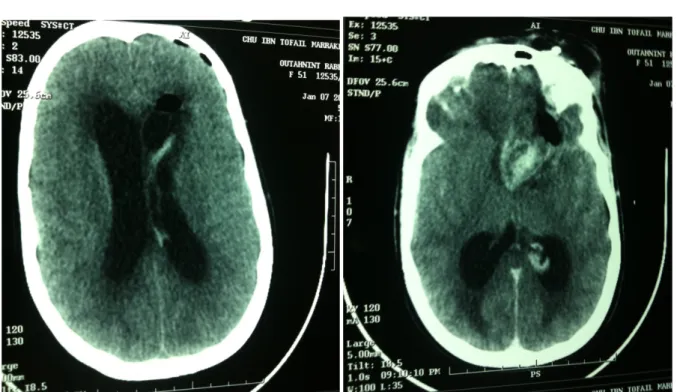 Figure 5 : Hémorragie intraventriculaire avec pneumocephalie frontale gauche,   sur scanner de contrôle a J1 post-opératoire