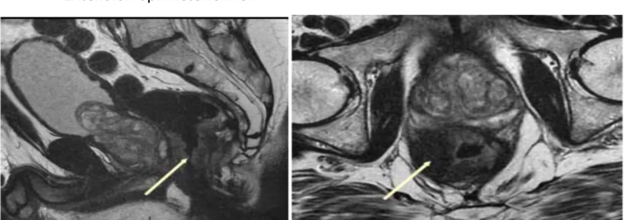 Figure XI et XII : Tumeur bas située avec infiltration inféro latérale de l’appareil sphinctérien(  service de radiologie CHU Mohamed VI) 