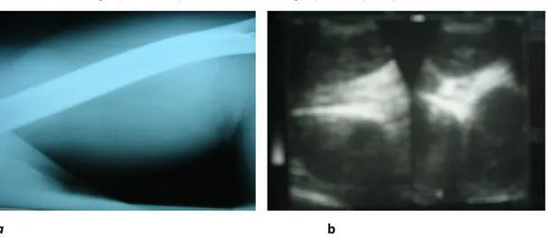 Figure 2 : opacité tissulaire sans lésion osseuse ni calcifications [a]. Image d’allure  kystique évocatrice de KH [b]