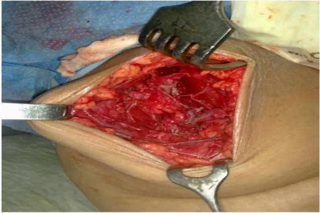 Figure 25 : cavité résiduelle per-opératoire.    