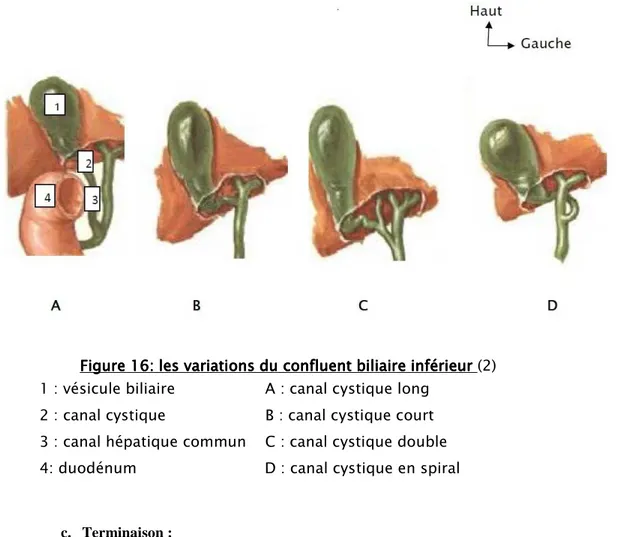 Figure 16: les variations du confluent biliaire inférieur : les variations du confluent biliaire inférieur : les variations du confluent biliaire inférieur    (2)     : les variations du confluent biliaire inférieur 1 : vésicule biliaire                   A : canal cystique long 