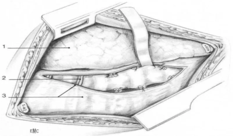 Figure    6 6 6    :::: Aspect opératoire de la plèvre pariétale incisée, les vaisseaux intercostaux sectionnés  6 entre deux ligatures et exposition du rachis[37] [37][37] [37]