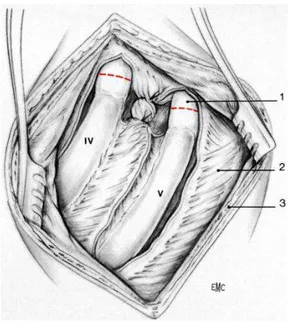 Figure    8 8 8 8    ::::Aspect opératoire après section du muscle grand dorsal pectoral [6] [6] [6] [6] 