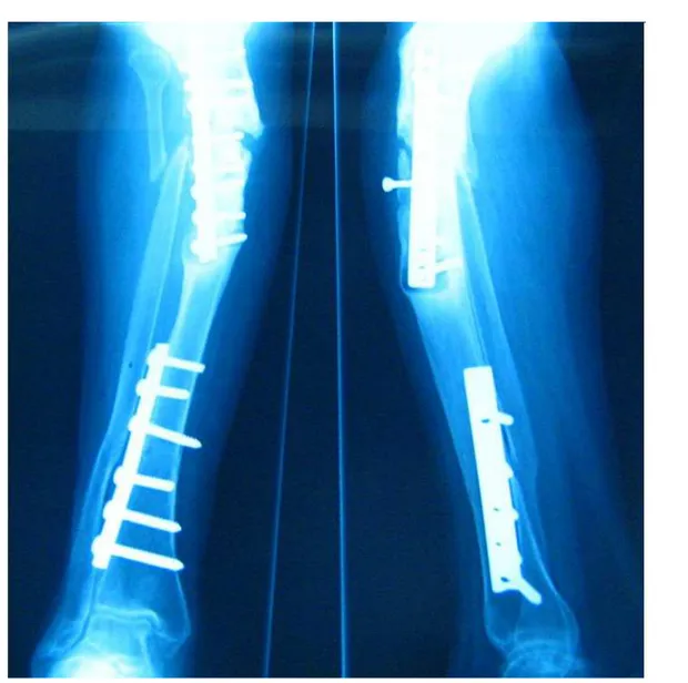 Figure n°9 9 9 9a a a    :  a :  : Radiographie de face et profil d’une jambe gauche siège   :  d’une pseudarthrose diaphysaire tibiale 
