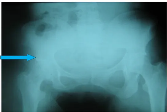 Figure    n° n° n°1 n° 1 1 12 2 2    a 2 a a    :  a :  : Radiographie de face du bassin montrant une dysplasie du cotyle droit  : 