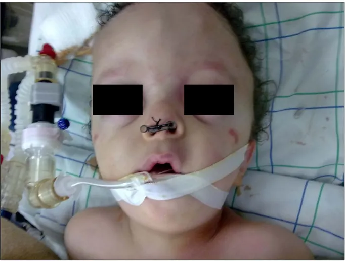 Figure N°12 : Calibrage chez un nouveau né opéré pour atrésie choanale (vue de face). 