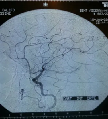 Figure 17 : artériographie normale d’un patient présentant un hématome pariétale gauche