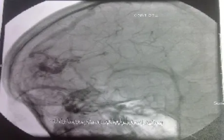 Figure n°11  : existence d’une grosse malformation artério-veineuse fronto-temporale droite  alimentée par les branches de l’artère sylvienne et l’artère cérébrale antérieure droites