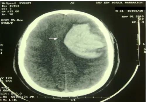 Figure n°12 : hématome parenchymateux fronto-pariéto-temporale gauche avec important effet  de masse avec hémorragie ventriculaire gauche et une hémorragie méningé