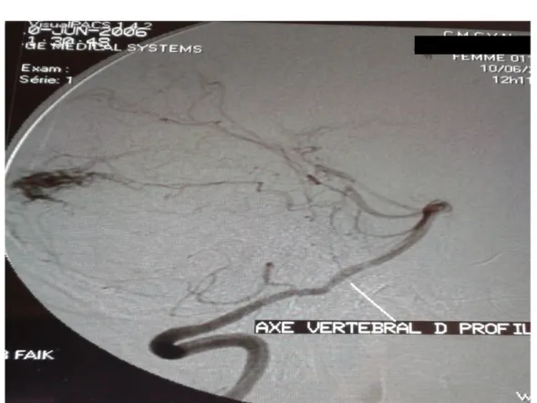 Figure n°18 : artériographie cérébrale d’une malformation arterio-veineuse    de la FCP alimenté par l’axe vertébral droit