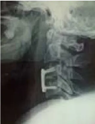 Figure 3    ::::    Radiographie standard du rachis cervical de profil en postopératoire montrant   Une arthrodèse par abord antérieur par système de fixation d’ostéosynthèse plaque et vissage  