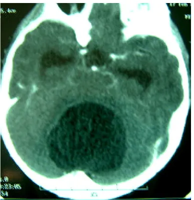 Fig n°7 : Une TDM cérébrale en coupe axiale montrant    un volumineux kyste dermoïde vermien hypodense non rehaussé
